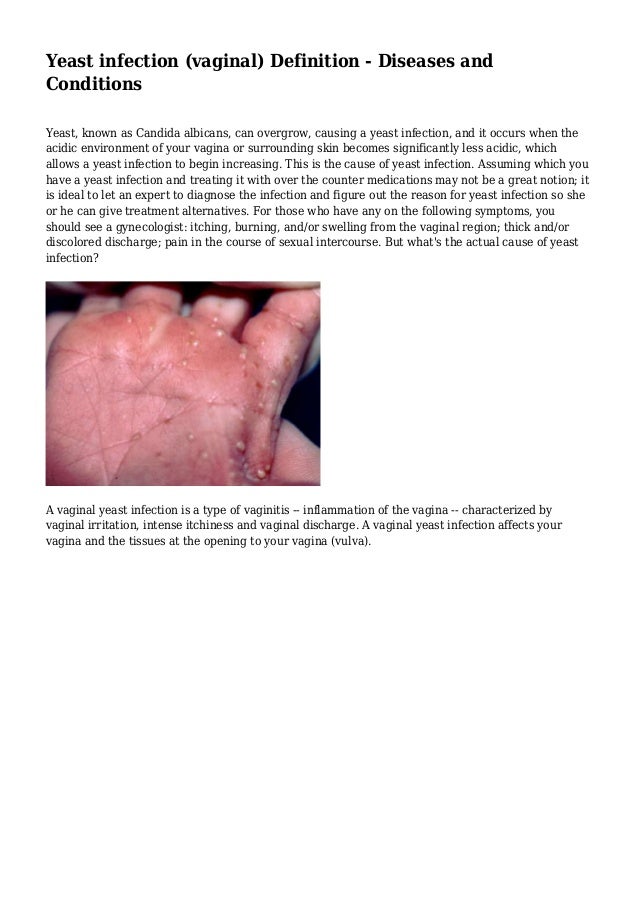 Yeast Infection Vagina Yeast Infection Vagina